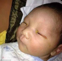 Em bé mù một mắt vì người chụp ảnh quên tắt đèn Flash khi chụp gần